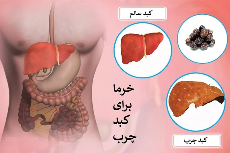 فواید خرما برای درمان سیروز کبدی